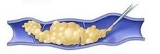 Foamsclerotherapie1